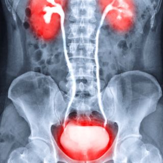 Protezione delle Vie Urinarie